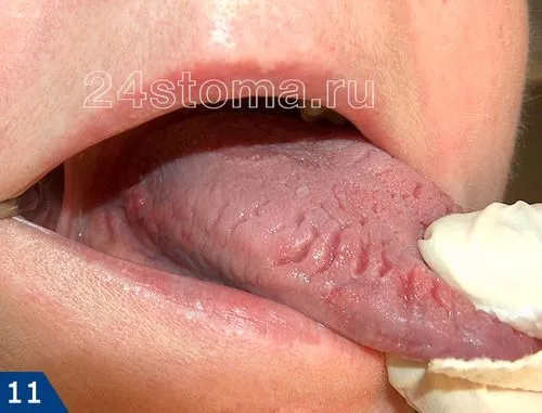 як лікувати червоний язик