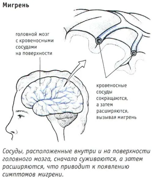 як лікувати мігрень вагітним