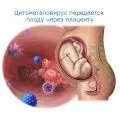 як лікувати цитомегаловірус під час вагітності