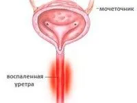 як вилікувати уретрит раз і назавжди
