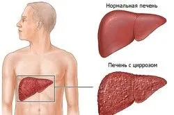 як лікувати камені в жовчних протоках