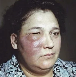 як лікувати флюс ясна