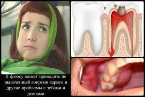 як лікувати флюс ясна