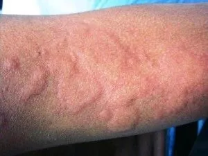 як лікувати кропивницю раз і назавжди