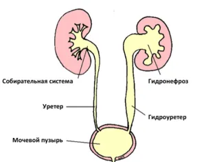 Гідронефроз при вагітності як лікувати нирки у вагітних