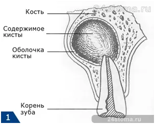 як вилікувати кісту зуба без операції