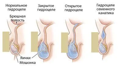 як вилікувати кісту яєчка у чоловіків народними засобами