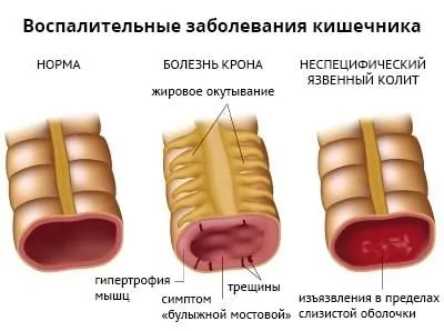як лікувати якщо болить кишечник