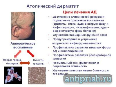 як вилікувати атопічний дерматит у немовляти
