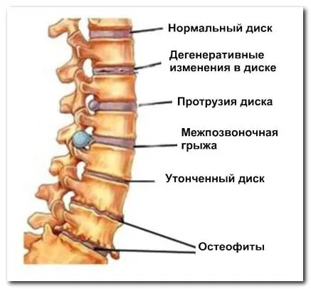 як лікувати остеохондроз шийного та грудного відділу хребта