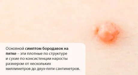 як вилікувати бородавки на п'яті