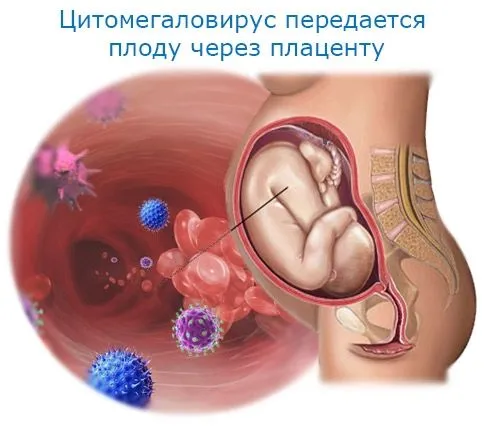як лікувати цитомегаловірус під час вагітності