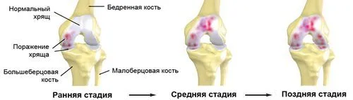 ніж лікувати суглоби в колінах
