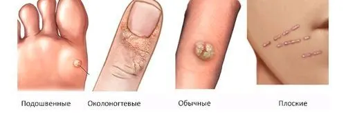 папіломи у дітей лікування