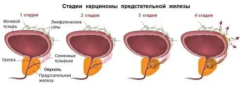 Як визначити рак простати за симптомами? якщо не лікувати рак простати