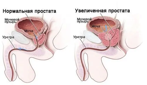 Як визначити рак простати за симптомами? якщо не лікувати рак простати