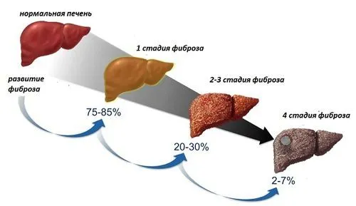 як лікувати цироз печінки 4 стадії