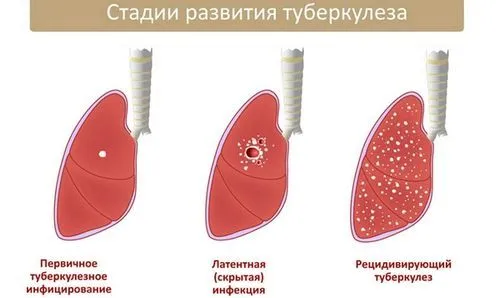 як передається туберкульоз закрита форма