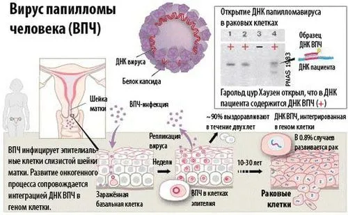як лікувати папіломи вірусна інфекція