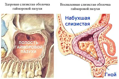 як лікувати синусит при годуванні груддю
