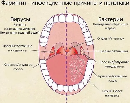 вилікувати фарингіт раз і назавжди