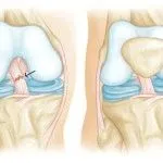 як лікувати частковий розрив передньої хрестоподібної зв'язки