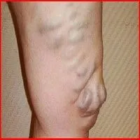 як лікувати варикоз АЛМАГ