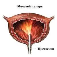 невроз сечового міхура і його лікування