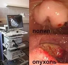 як лікувати понос на 32-му тижні вагітності