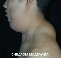 ніж лікувати жировик на шиї
