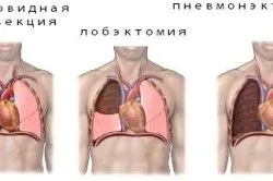 нове в лікуванні туберкульозу легенів