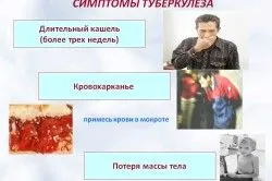 нове в лікуванні туберкульозу легенів