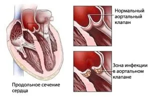 як лікувати ревматизм після ангіни