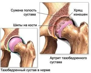 як лікувати ревматизм після ангіни
