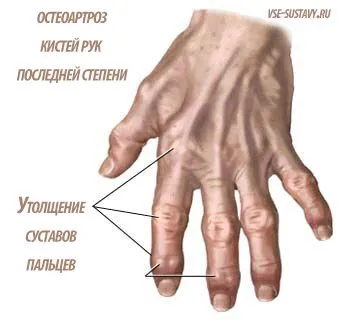 як лікувати остеопороз рук