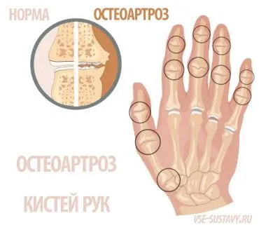 як лікувати остеопороз рук