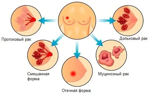 як лікувати осередкову мастопатію