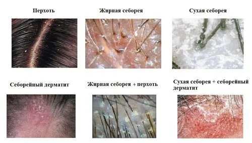 як лікувати себорейний дерматит в домашніх умовах
