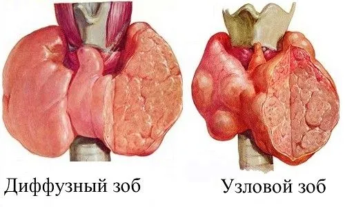 як вилікувати зоб народна медицина