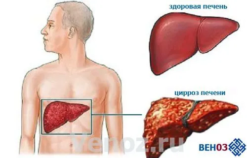 варикозне розширення вен стравоходу цирозі печінки варикоз ранніх стадіях народними засобами ступеня