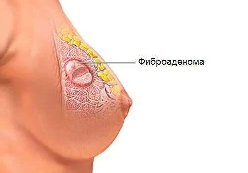 як лікувати осередкову мастопатію