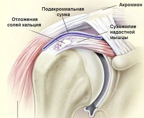 якщо не лікувати розтягнення зв'язок