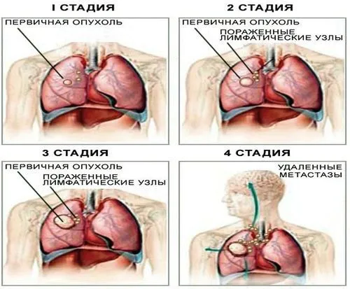 Рак бронхів: види, причини, ознаки, симптоми, лікування як лікувати рак бронхів