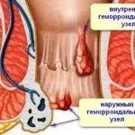 лікувати геморой запущений