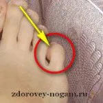 як лікувати забій мізинця ноги