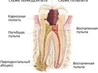 як лікувати кісту на яснах