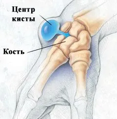 як лікувати кісту Беккера під коліном
