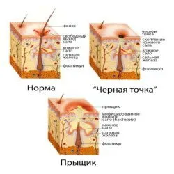 фурункул