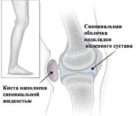 як лікувати кісту Беккера під коліном