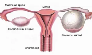 як вилікувати кісту правого яєчника